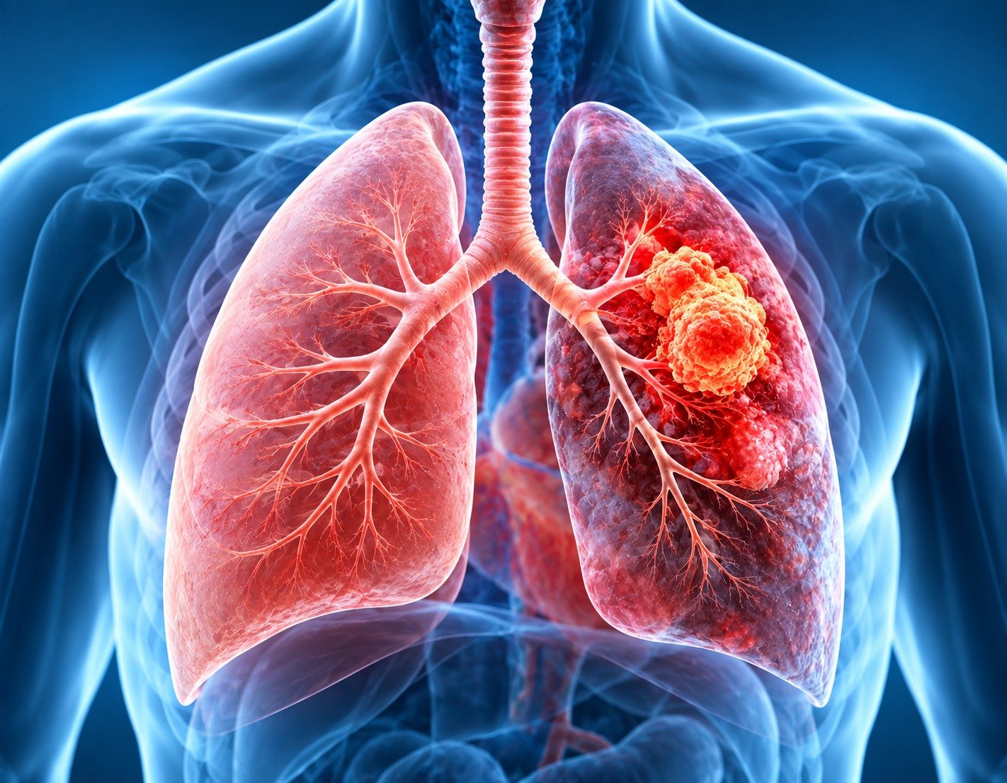Lung Cancer